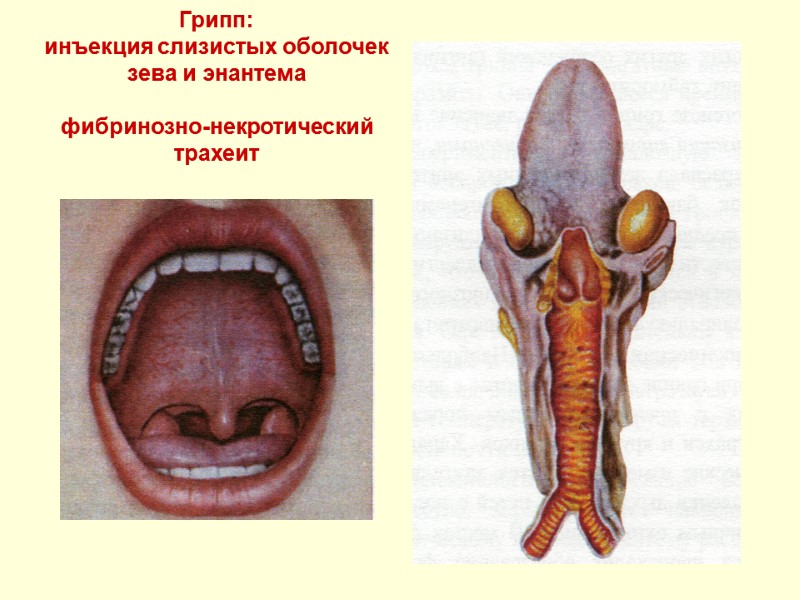 Грипп:  инъекция слизистых оболочек зева и энантема  фибринозно-некротический трахеит